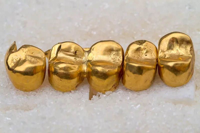 Sälja Tandguld: Förvandla Dentalguld till Pengar